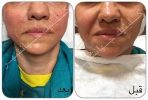 لیفت نخ کاگ، بالا کشیدن گونهها و رفع خطوط خنده ترکیب با تزریق ژل خط خنده - 3