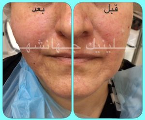 لیفت نخ کاگ، بالا کشیدن گونهها و رفع خطوط خنده ترکیب با تزریق ژل خط خنده - 1