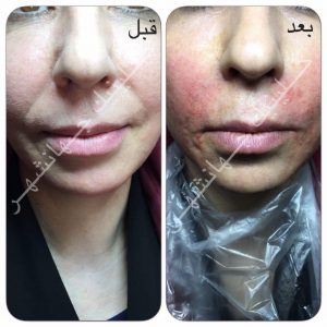 لیفت نخ کاگ، بالا کشیدن گونهها و رفع خطوط خنده ترکیب با تزریق ژل خط خنده - 4