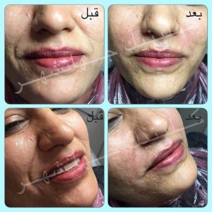 لیفت نخ کاگ، بالا کشیدن گونهها و رفع خطوط خنده ترکیب با تزریق ژل خط خنده - 5