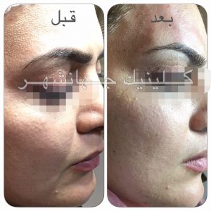 لیفت نخ کاگ، بالا کشیدن گوشه چشم و ابرو