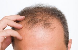 روش های درمان ریزش مو مردان